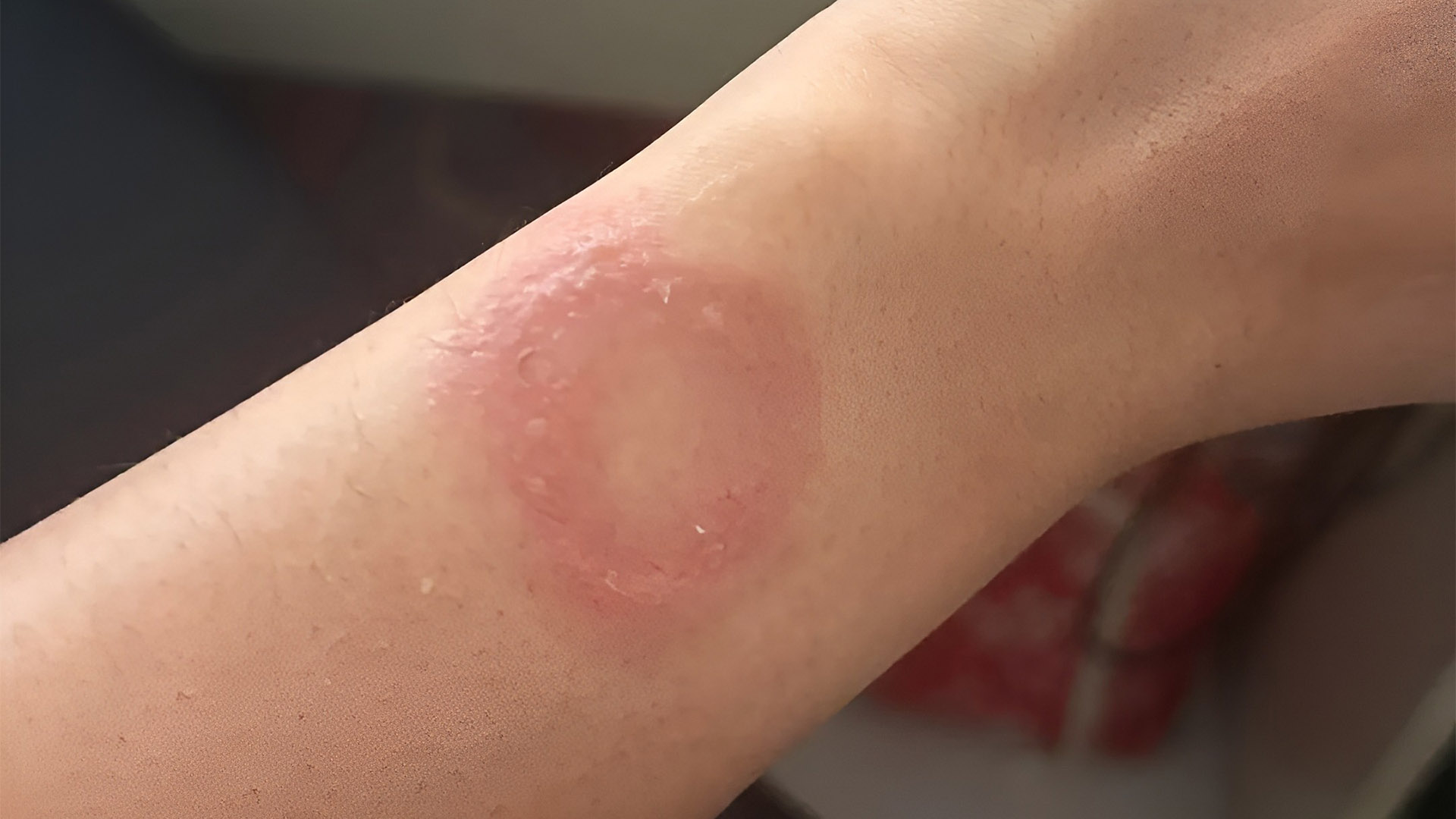 Apple Watch owner says the wearable caused a wrist burn